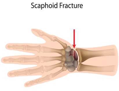 3-Image-OP-Definitin and causes-Scaphoid bone